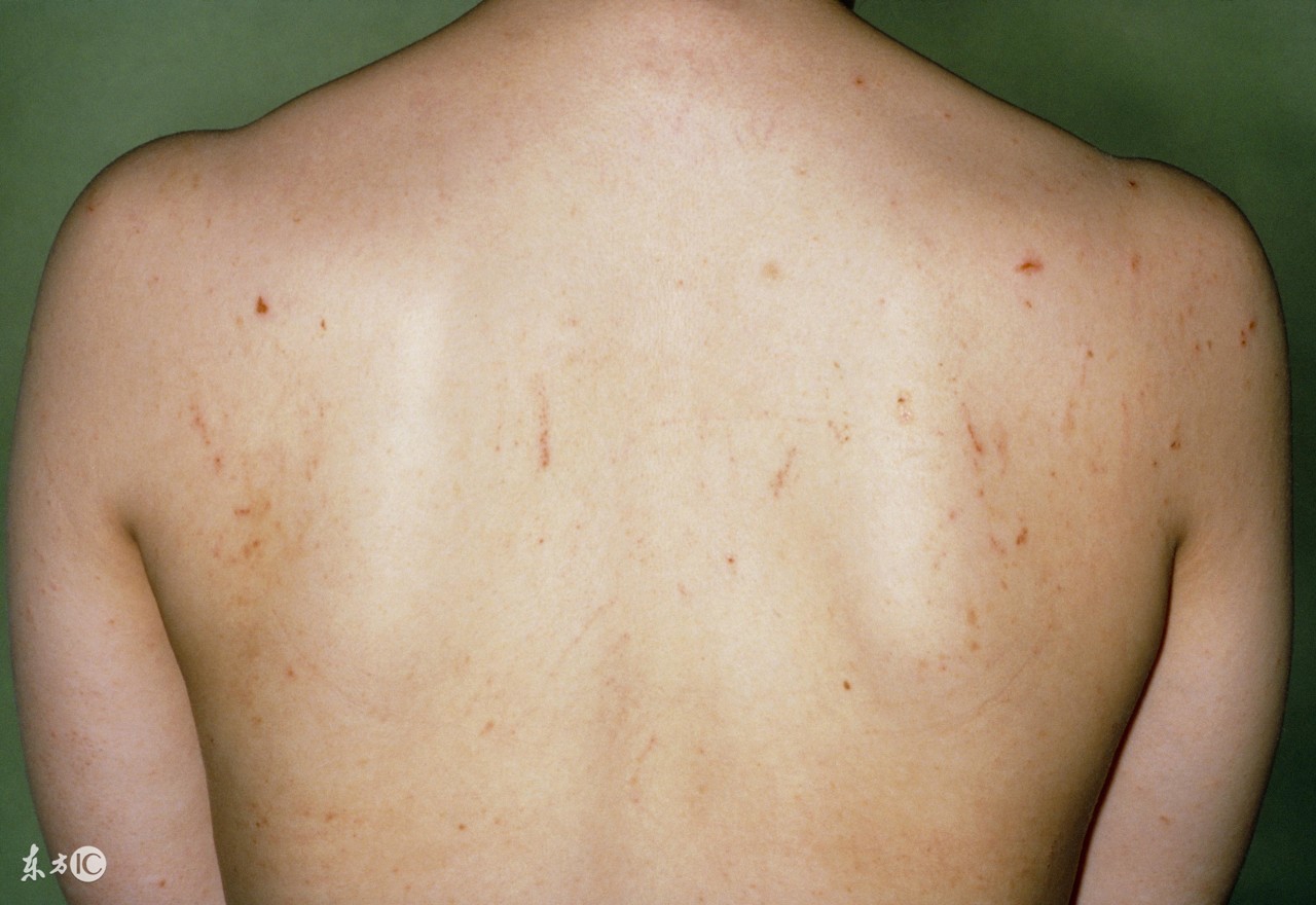 预防疥疮应采取以下措施,治疗疥疮最有效的方法