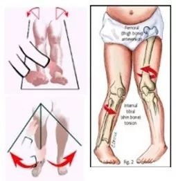 内八字脚外侧骨头突出,外八字脚好不好