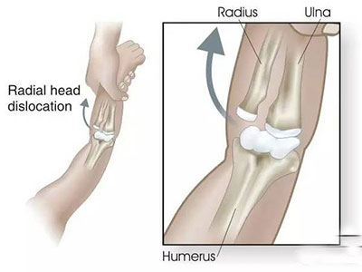小儿桡骨头半脱位的治疗视频,小儿桡骨头半脱位复位