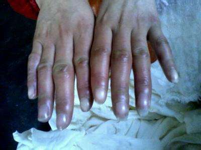 脚上冻疮怎么办,根治冻疮特效药