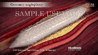 不做支架不搭桥中医调理冠心病,冠心病支架和搭桥的条件