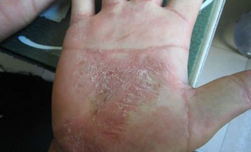 牛皮癣不是遗传的可以痊愈吗,爸爸后天有牛皮癣会遗传孩子吗