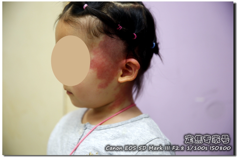 脸上大面积起红斑怎么回事,脸上起指甲大小的红斑