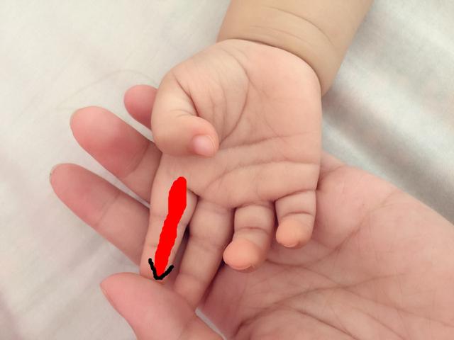 黄疸指数超过15就是病理性黄疸吗,宝宝黄疸偏高宝妈吃什么可以缓解