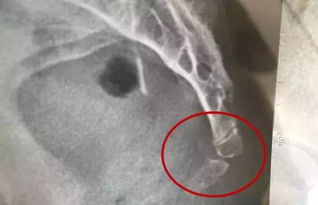 人类尾巴尾椎骨疼痛什么原因,为什么尾巴会痛