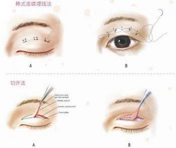 双眼皮埋线一般维持多久,双眼皮埋线能保持多长时间