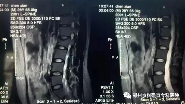 强直性脊柱炎需要做什么检查确诊,强直性脊柱炎要做什么检查确诊