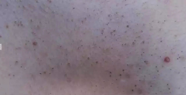 酒渣鼻严重怎么彻底治疗,酒渣鼻难道真的看不好吗