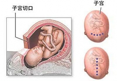 剖宫产分娩选择,剖腹产和顺产到底该如何选择