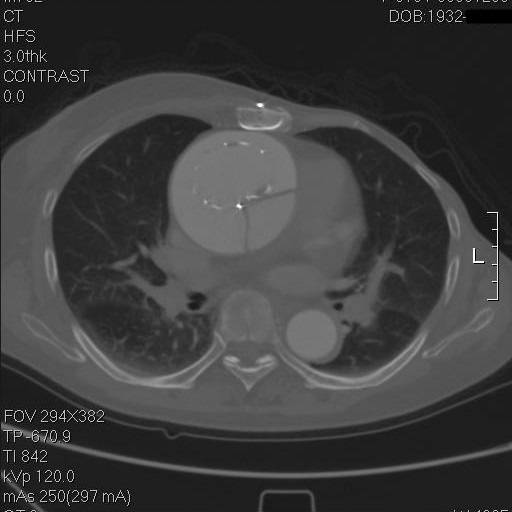 主动脉夹层袭来的恐慌,你不懂