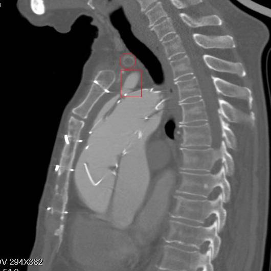 主动脉夹层早期征兆35岁,主动脉夹层早期征兆心率