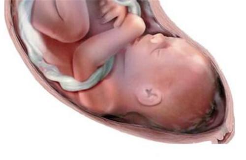 怀孕33周，脐绕颈1周，孕期怎么做可以避免这种情况发生