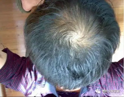 头顶头发稀疏毛囊是否坏死,因为脱发怎么知道毛囊有没有坏死