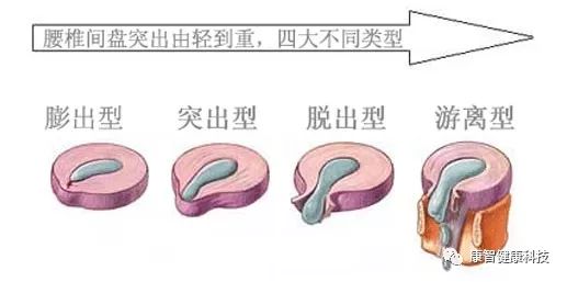 推拿按摩可以把突出的椎间盘按回去吗？