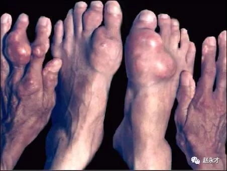 痛风中医讲座,教你一招根治痛风