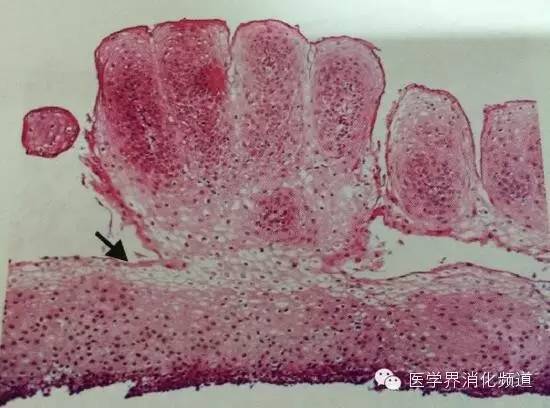 食管良性肿瘤科普视频,食管乳头状瘤和增生区别