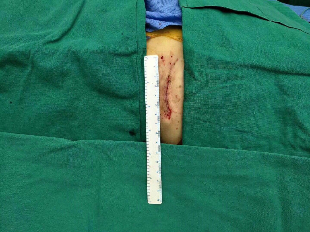 微新闻｜心脏“阀门”关不紧，专家妙手装“新门”——华南中医系统首例！广东省中医院完成经心尖微创主动脉瓣置入术（TAVI）