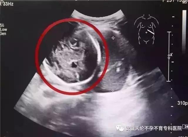 怀孕6个月子宫下垂,怀孕6个月子宫前位