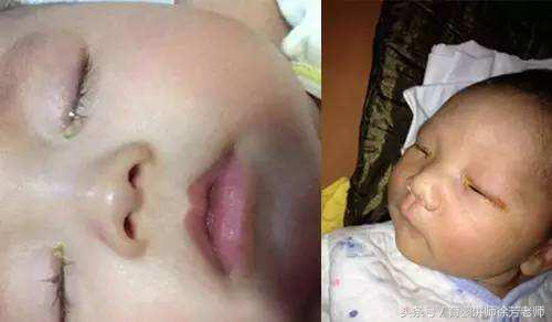 宝宝有眼屎吃什么调理,眼睛有眼屎是什么症状