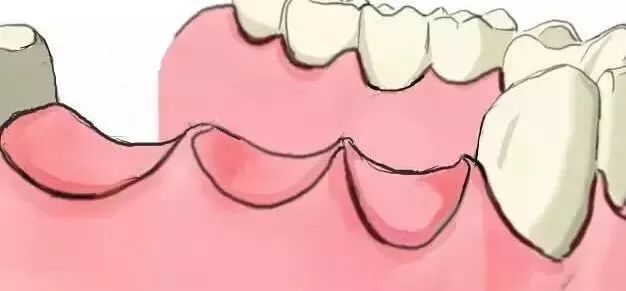 多颗牙缺失做烤瓷牙还是种植牙好,牙齿缺失是种植牙好还是烤瓷牙好