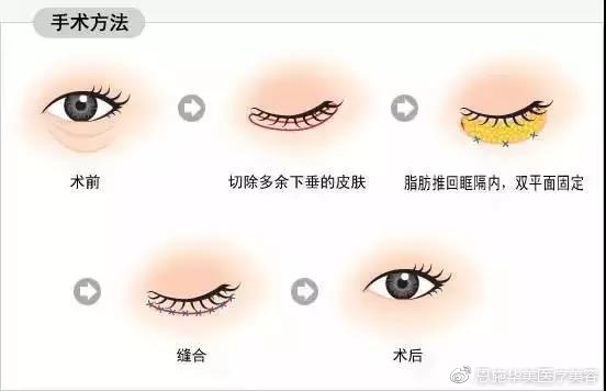 眼部整形常见的15个问题,眼部护理要避开九大误区