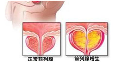 了解男言之隐——前列腺，关爱老公和老爸