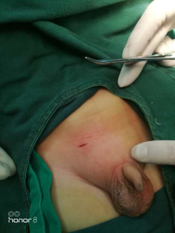 西乡县县医院小儿疝气手术,太和医院疝气微创手术