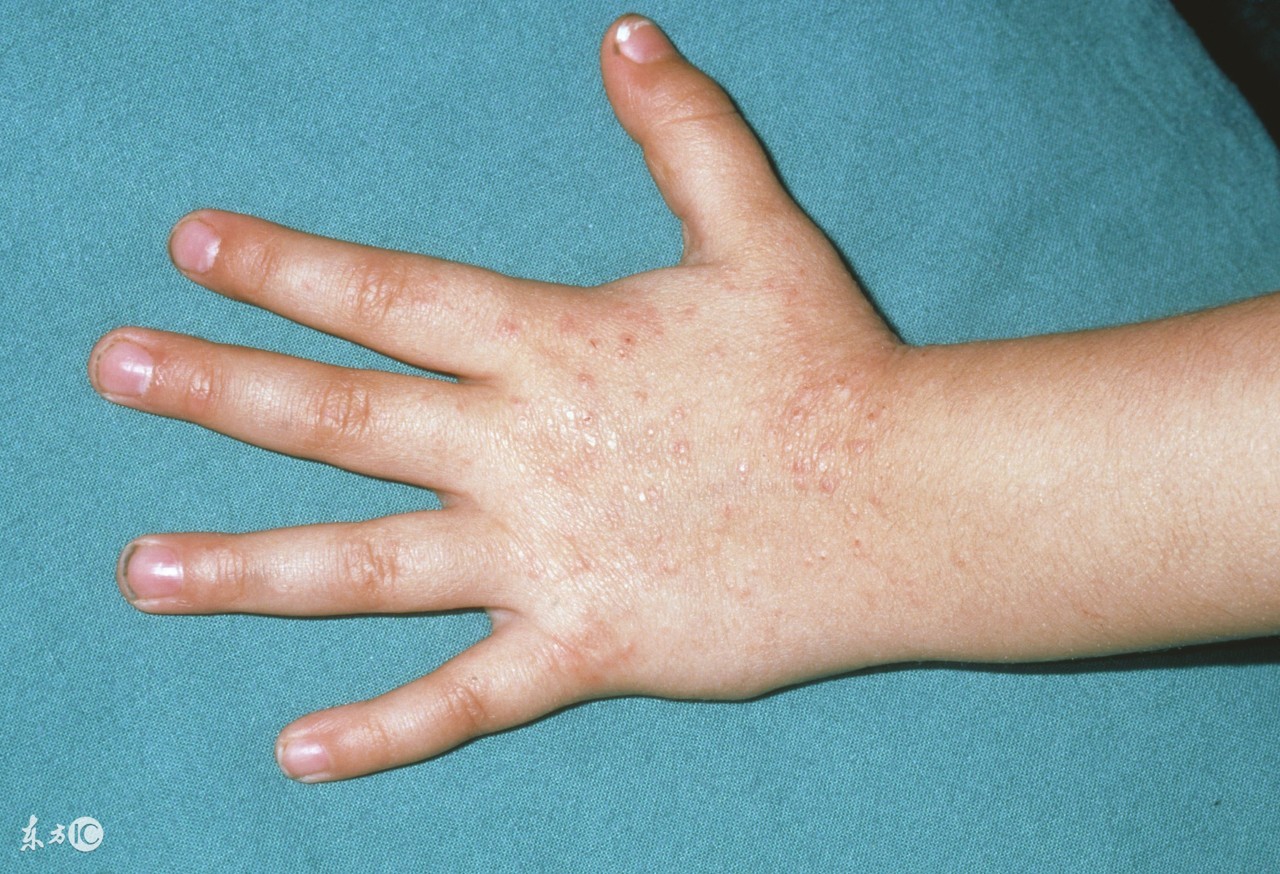 面部接触性皮炎是什么引起的,什么是接触性皮炎图片大全