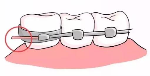 戴牙套扎嘴怎么办,牙套铁丝末端扎嘴怎么办