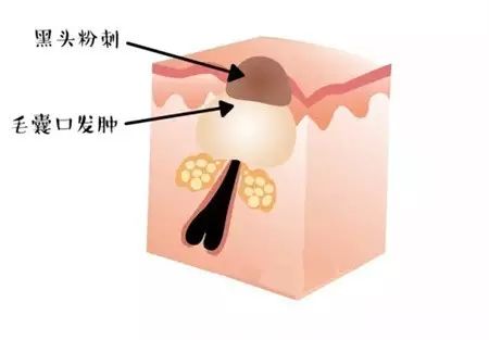 真假黑头教你如何正确去黑头,如何辨别黑头以及正确使用产品