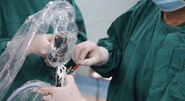 尿道口取石时痛不痛,尿道取石成功率高吗