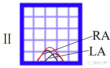 左心房肥大和右心房肥大心电图,心电图左室肥大右室肥大
