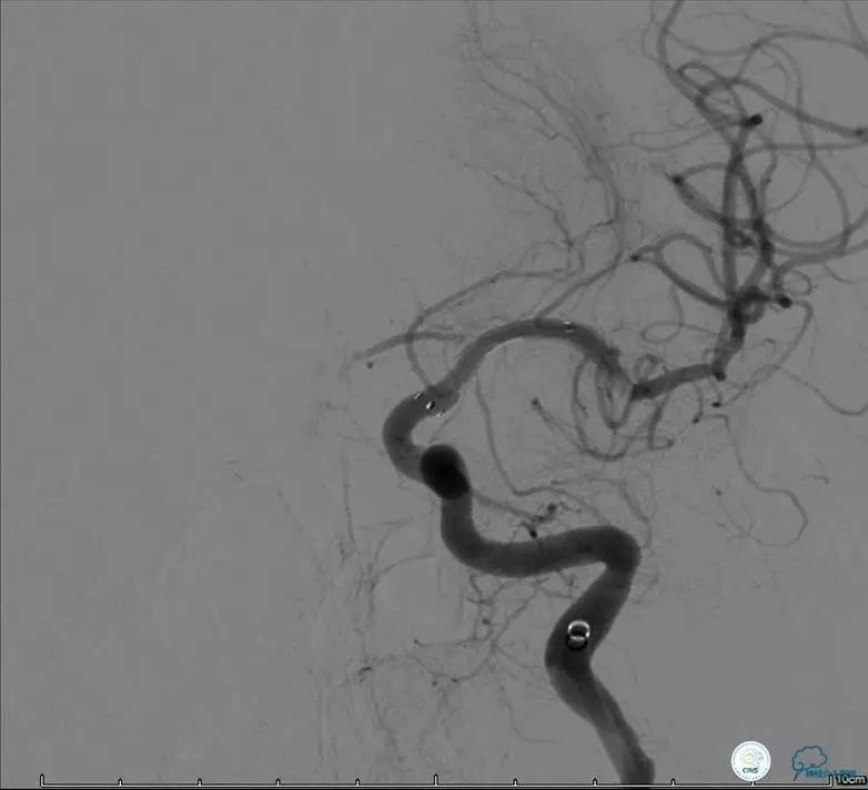 颅内动脉狭窄介入治疗研究,颅内血管cta副作用