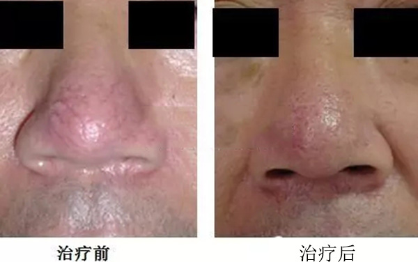 酒渣鼻严重怎么彻底治疗,酒渣鼻难道真的看不好吗