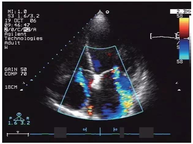 心脏扩大有什么症状和后果,心脏扩大症