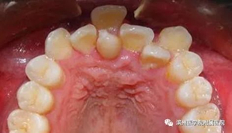 孩子牙缝很小需要干预吗,小朋友牙缝大可以干预吗