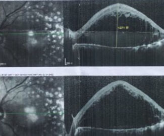 眼底黄斑凹陷怎么办,眼底黄斑怎么去除