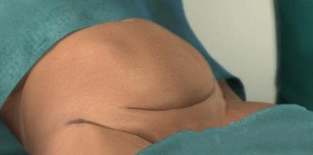 女人生孩子可以选择剖腹产吗,为什么女人生孩子会选择剖腹产