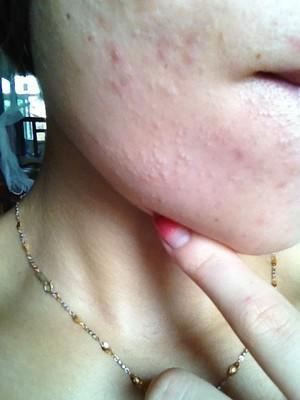 医生推荐祛痘印最有效的方法,去痘印省钱小技巧