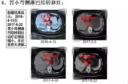 2023nkt细胞治疗肺癌效果,nkt肺癌免疫治疗