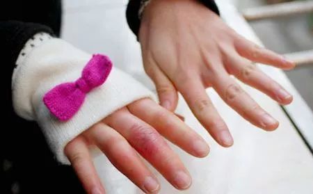 天气暖和也会长冻疮,天气太冷开始长冻疮了怎么办