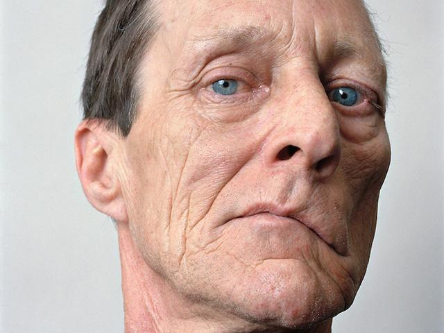 冷热交替吃东西补救办法,受凉嘴歪恢复期需要吃药吗