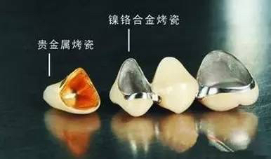 不锈钢牙和镍铬烤瓷牙的区别,烤瓷牙怎么选