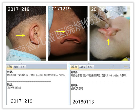 耳后的“血包“——神经外科医生巧判断，多学科会诊解难题