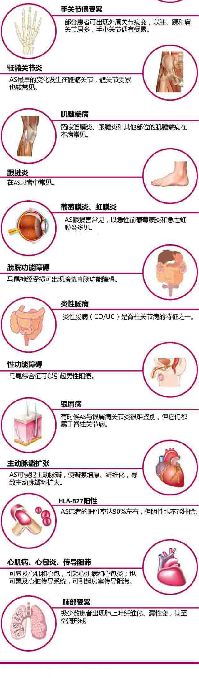 强直性脊柱炎的临床诊断,强直性脊柱炎诊断标准与治疗