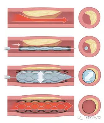 心血管软斑块危险,心血管软斑块和硬斑块的区别