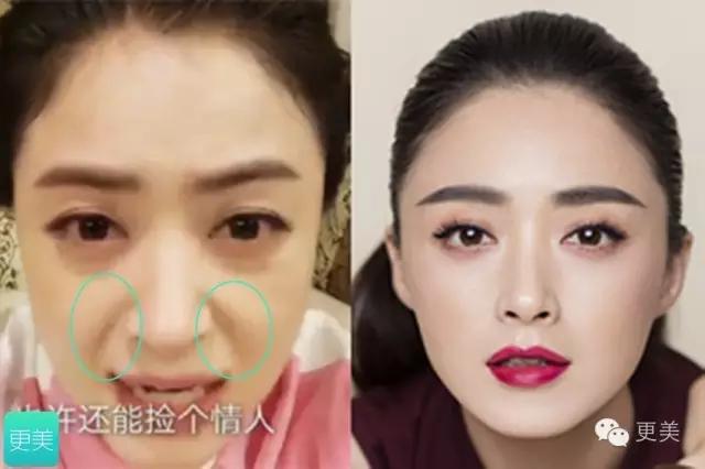 自体脂肪填充面部术后能坚持多久,自体脂肪填充面部术后1-3天变化图