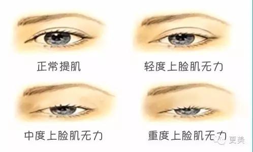 自体脂肪填充面部术后能坚持多久,自体脂肪填充面部术后1-3天变化图