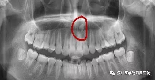 小孩的牙齿过长牙缝过大怎么办,牙齿有牙缝对孩子有影响吗