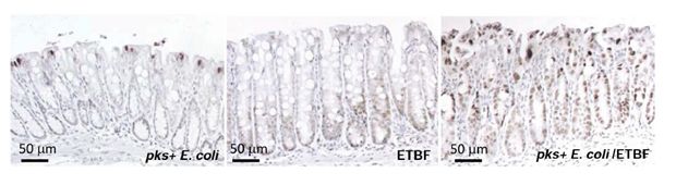 肠道菌群与癌症论文,21分钟详解肠道菌群与肿瘤5大问题